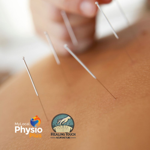My Local Physio Plus healing touch acupuncture rebecca aloisi acupuncture womens health ridgehaven golden grove
