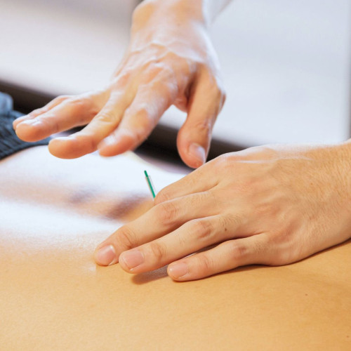 Dry Needling is it right for you reduce tension release muscle tighness